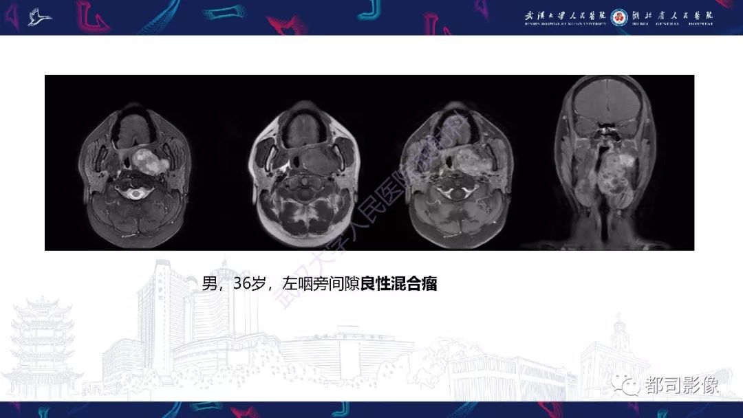 【PPT】咽旁间隙解剖及病变影像诊断