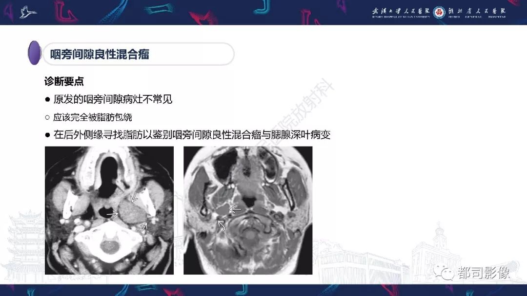 【PPT】咽旁间隙解剖及病变影像诊断