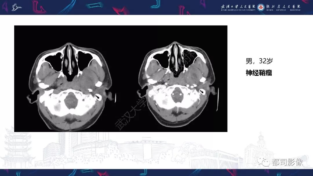 【PPT】咽旁间隙解剖及病变影像诊断