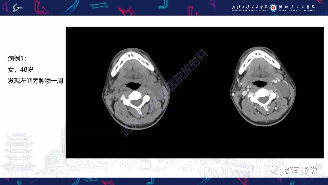 【PPT】咽旁间隙解剖及病变影像诊断