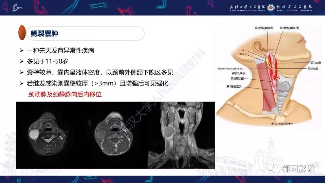 【PPT】咽旁间隙解剖及病变影像诊断