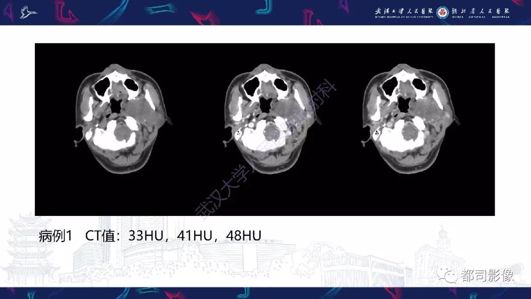 【PPT】咽旁间隙解剖及病变影像诊断