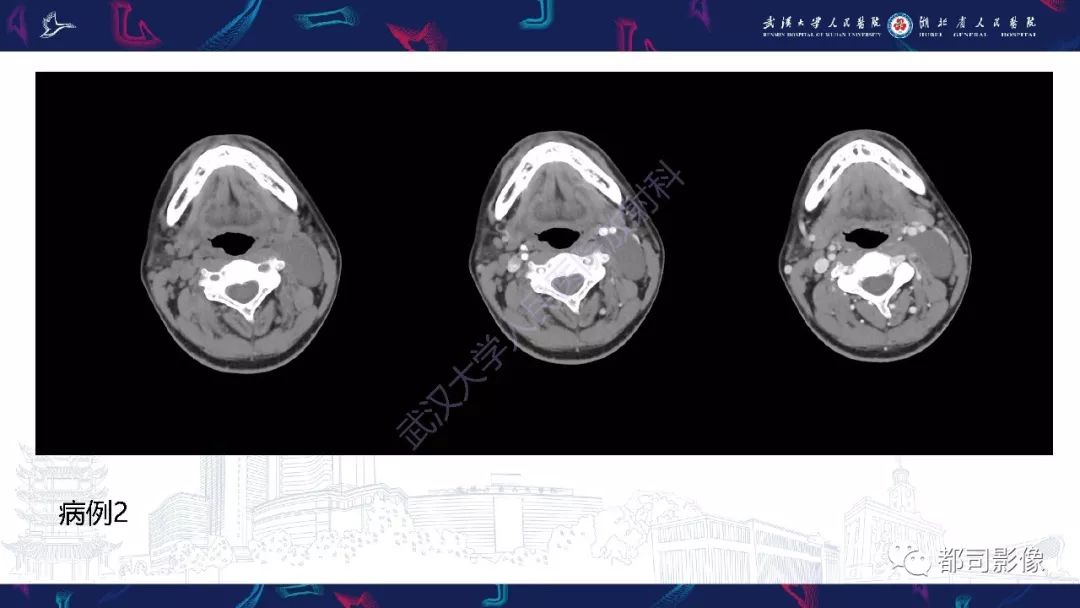 【PPT】咽旁间隙解剖及病变影像诊断