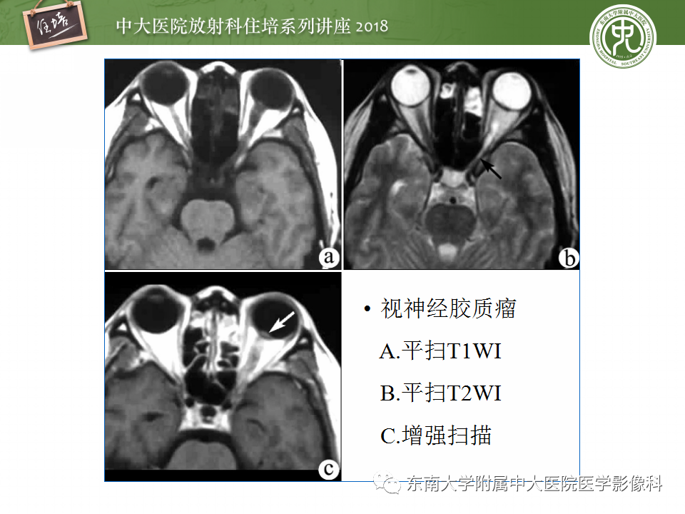 【PPT】眼眶内占位性病变的影像诊断