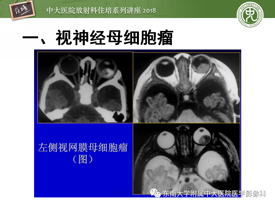 【PPT】眼眶内占位性病变的影像诊断