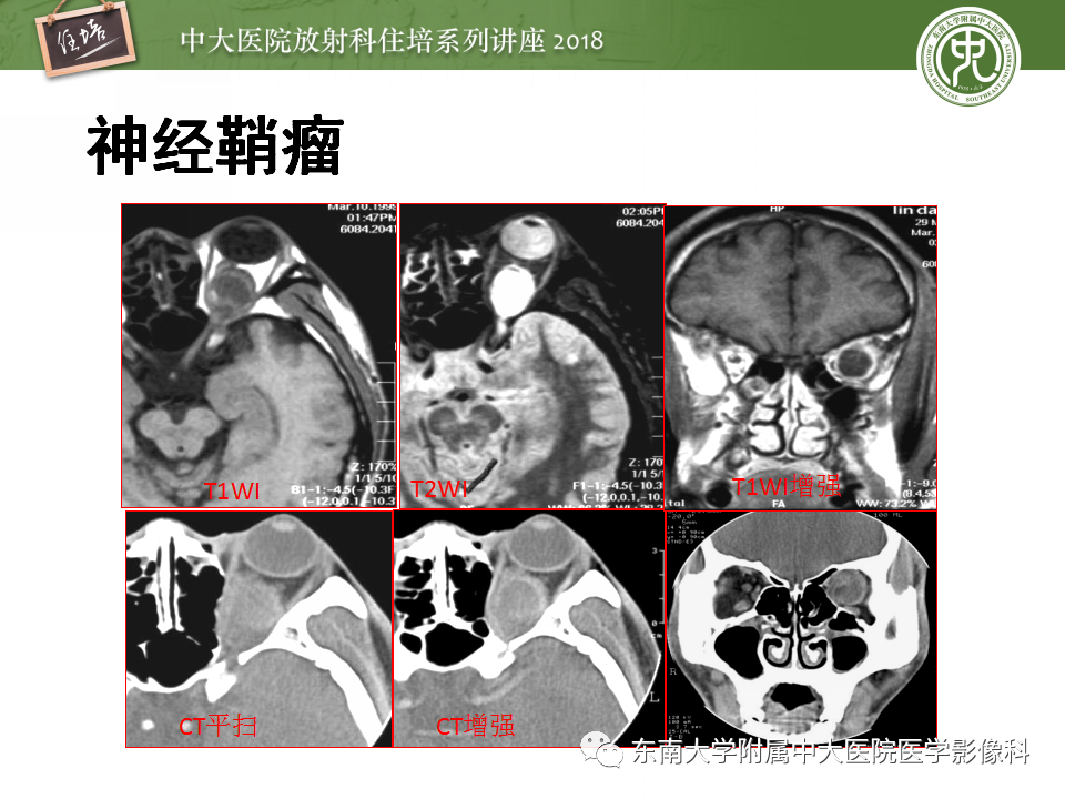 【PPT】眼眶内占位性病变的影像诊断
