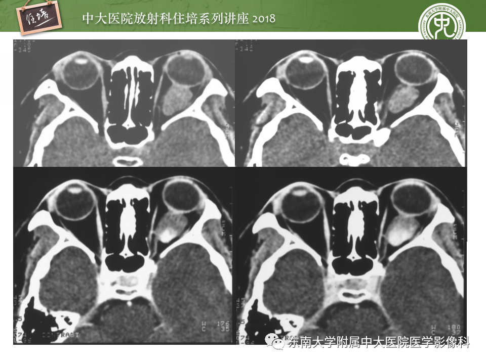 【PPT】眼眶内占位性病变的影像诊断