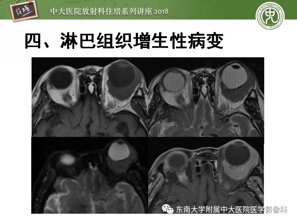 【PPT】眼眶内占位性病变的影像诊断