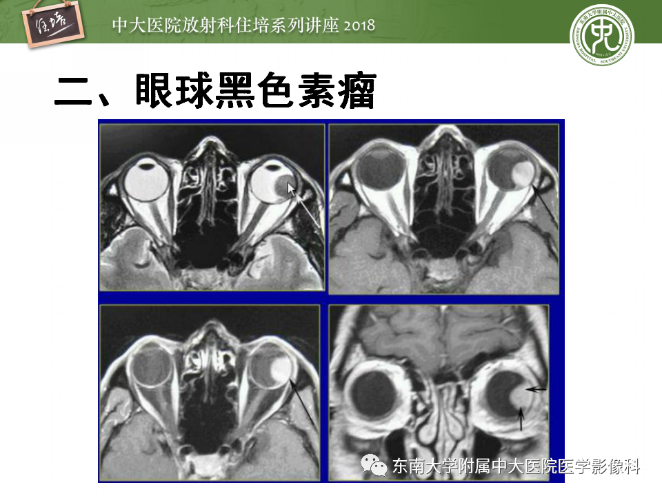 【PPT】眼眶内占位性病变的影像诊断