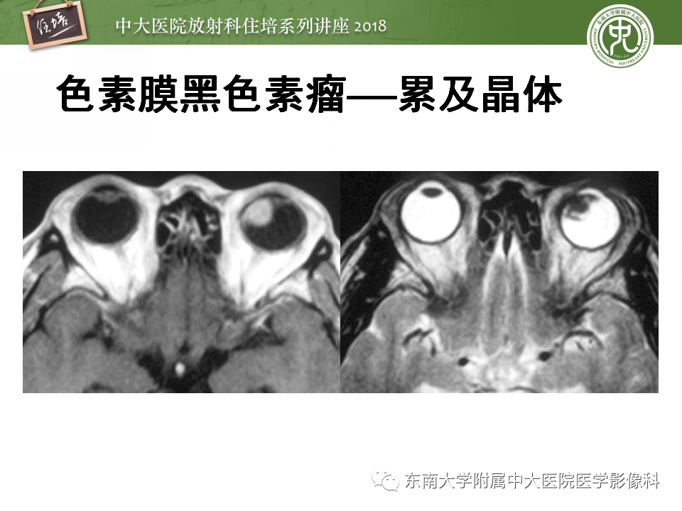 【PPT】眼眶内占位性病变的影像诊断