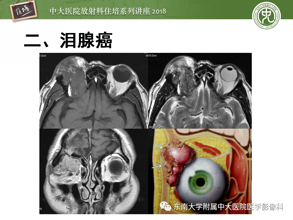 【PPT】眼眶内占位性病变的影像诊断