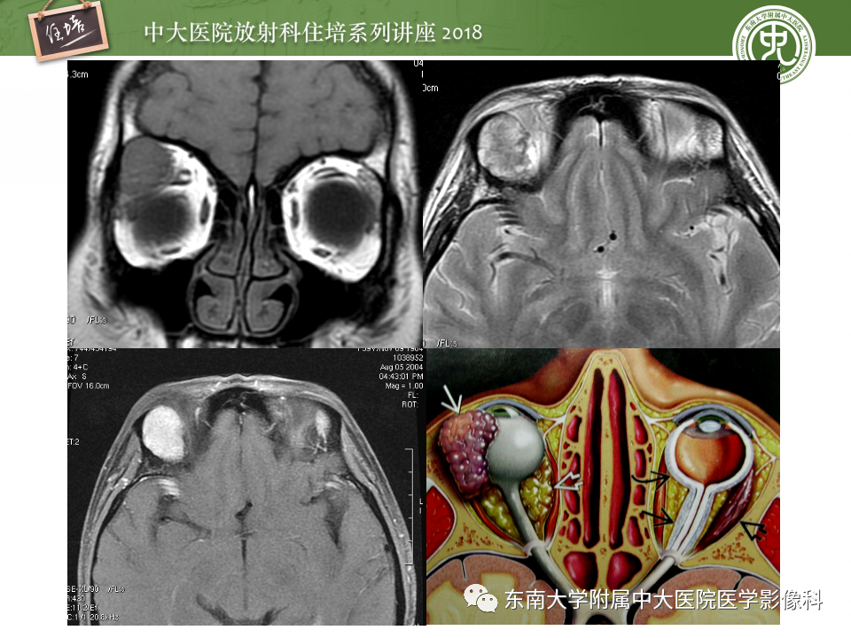 【PPT】眼眶内占位性病变的影像诊断