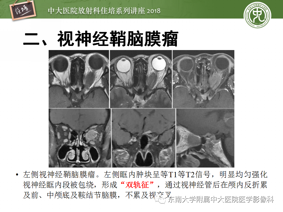 【PPT】眼眶内占位性病变的影像诊断