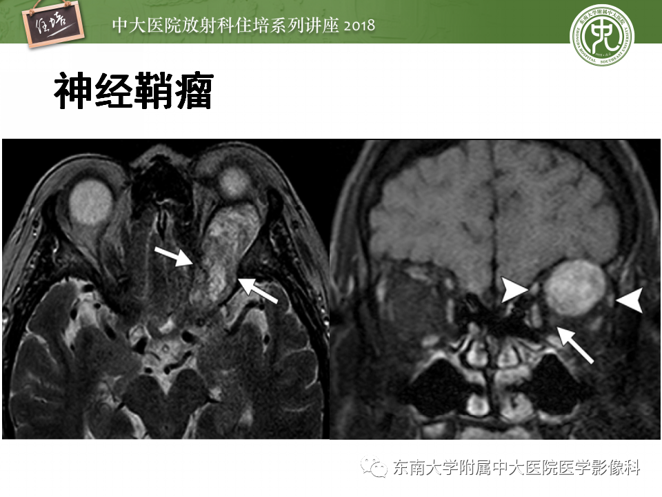 【PPT】眼眶内占位性病变的影像诊断