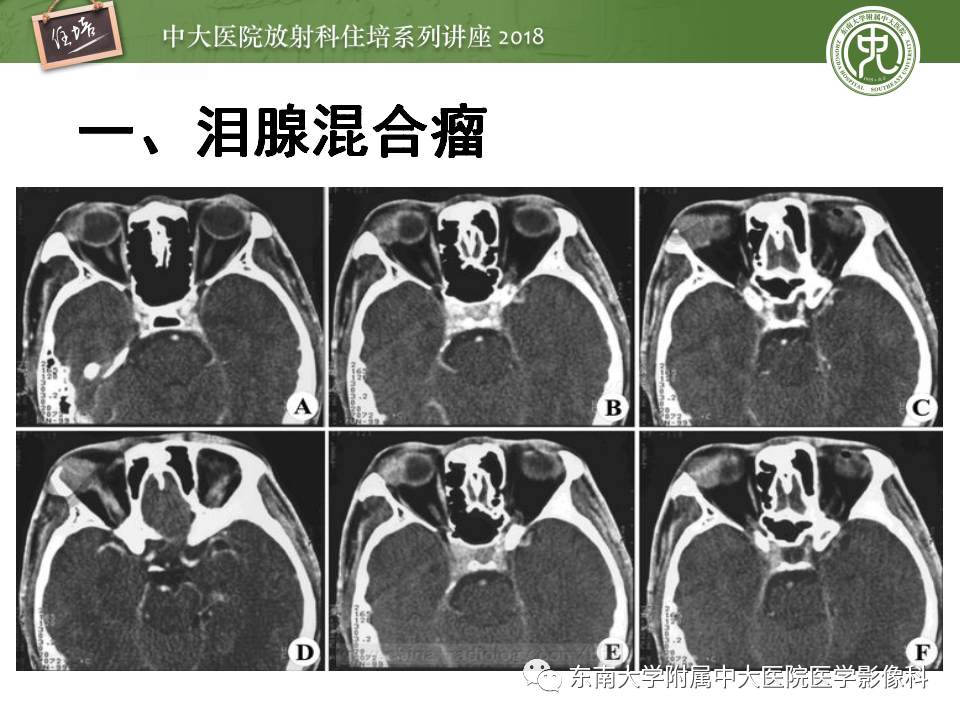 【PPT】眼眶内占位性病变的影像诊断