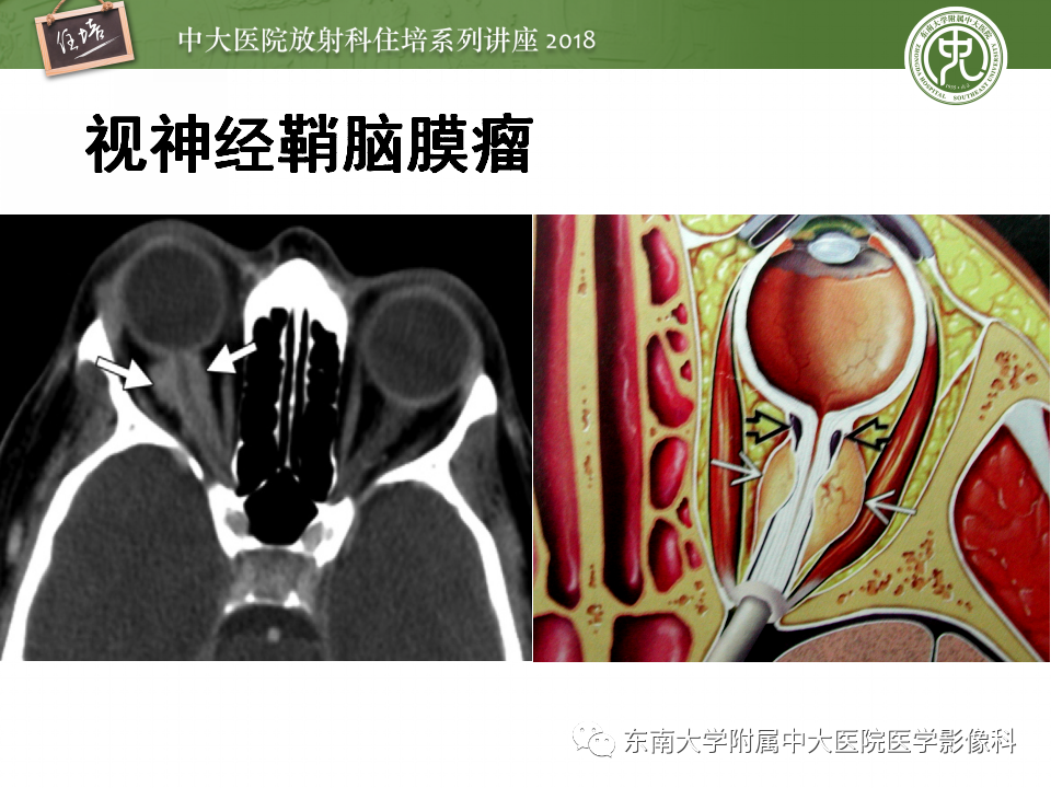 【PPT】眼眶内占位性病变的影像诊断