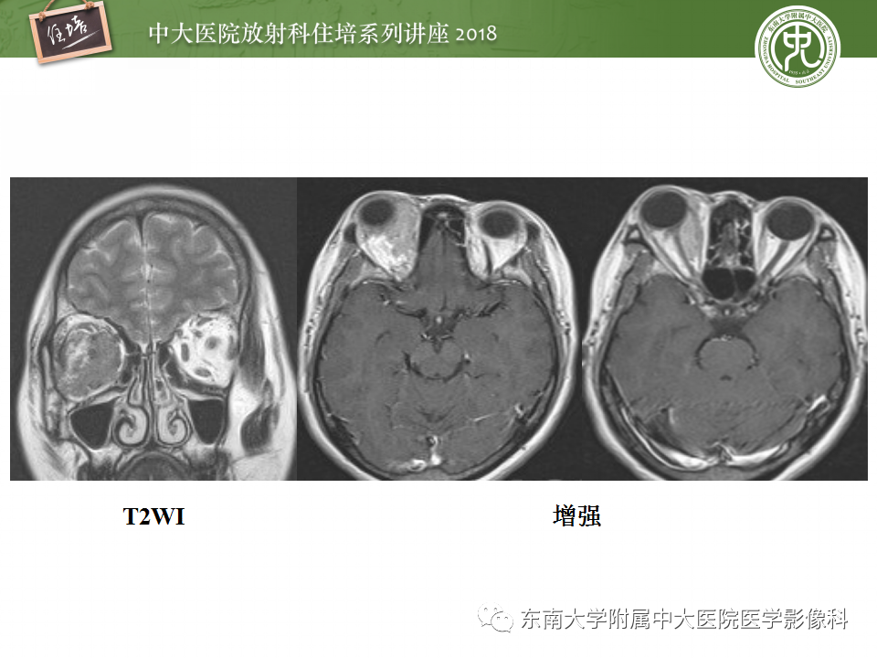 【PPT】眼眶内占位性病变的影像诊断