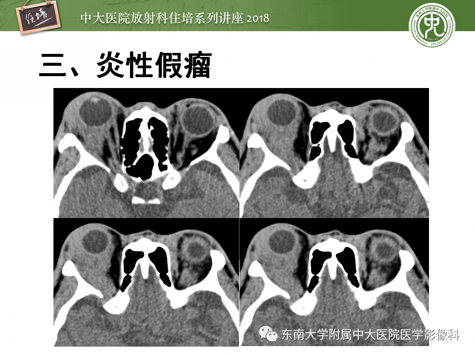 【PPT】眼眶内占位性病变的影像诊断