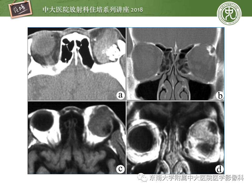 【PPT】眼眶内占位性病变的影像诊断