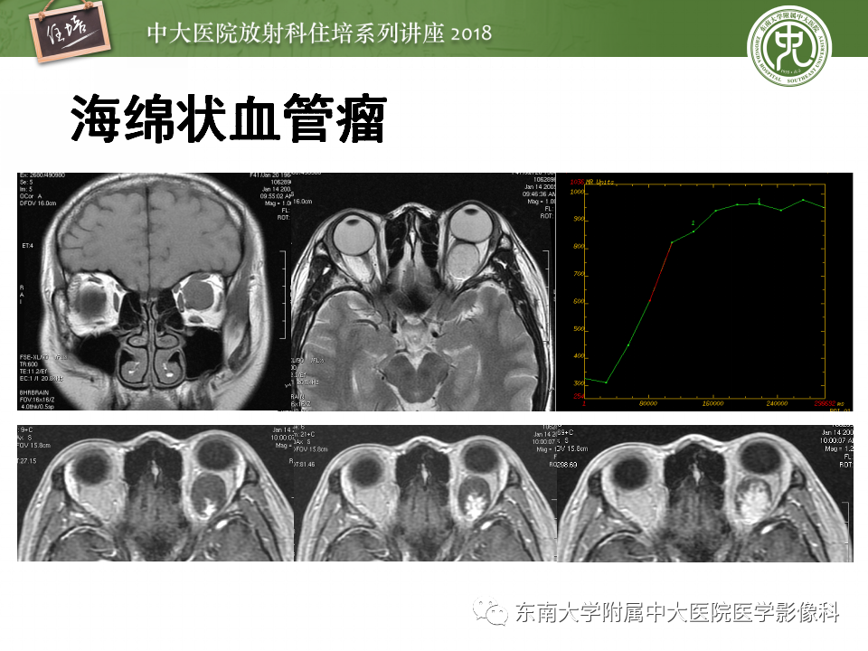 【PPT】眼眶内占位性病变的影像诊断
