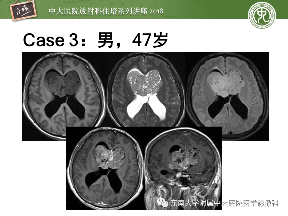 【PPT】脑室内肿瘤的影像学表现及鉴别