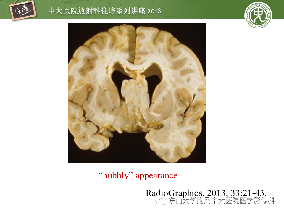 【PPT】脑室内肿瘤的影像学表现及鉴别