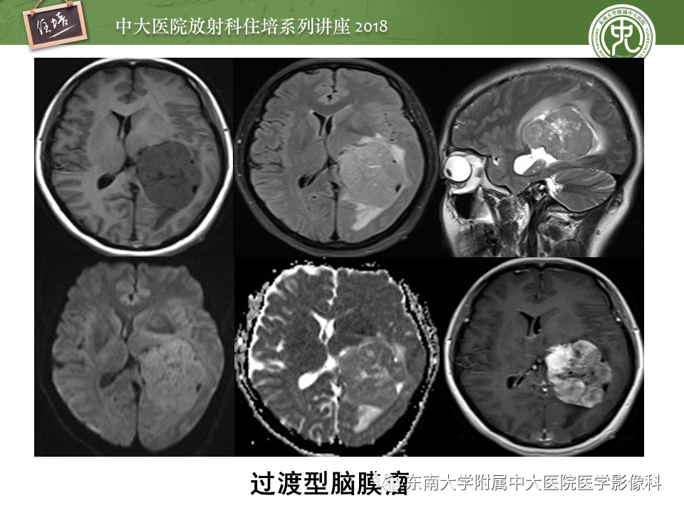 【PPT】脑室内肿瘤的影像学表现及鉴别