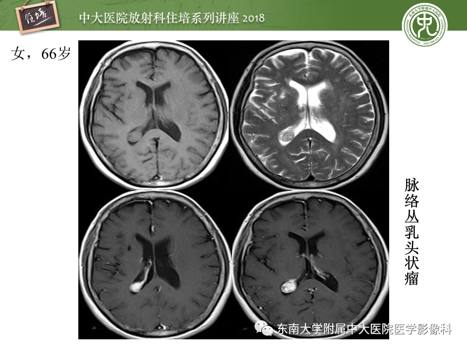 【PPT】脑室内肿瘤的影像学表现及鉴别