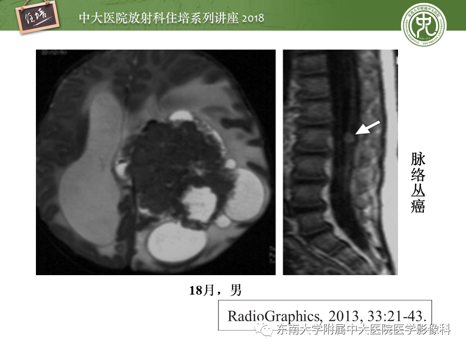 【PPT】脑室内肿瘤的影像学表现及鉴别