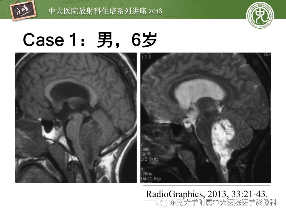 【PPT】脑室内肿瘤的影像学表现及鉴别