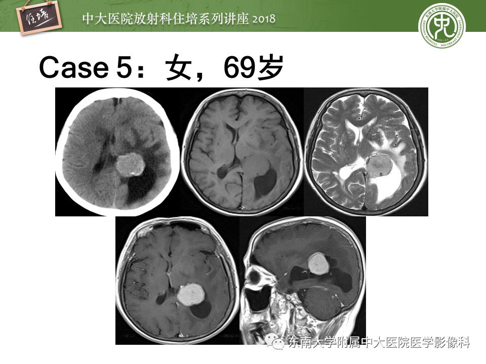 【PPT】脑室内肿瘤的影像学表现及鉴别