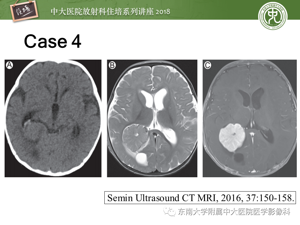 【PPT】脑室内肿瘤的影像学表现及鉴别