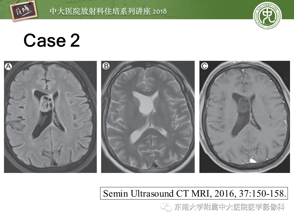 【PPT】脑室内肿瘤的影像学表现及鉴别