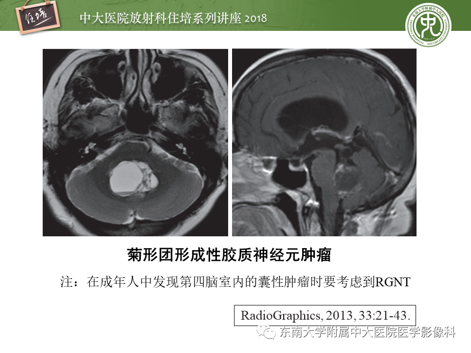 【PPT】脑室内肿瘤的影像学表现及鉴别