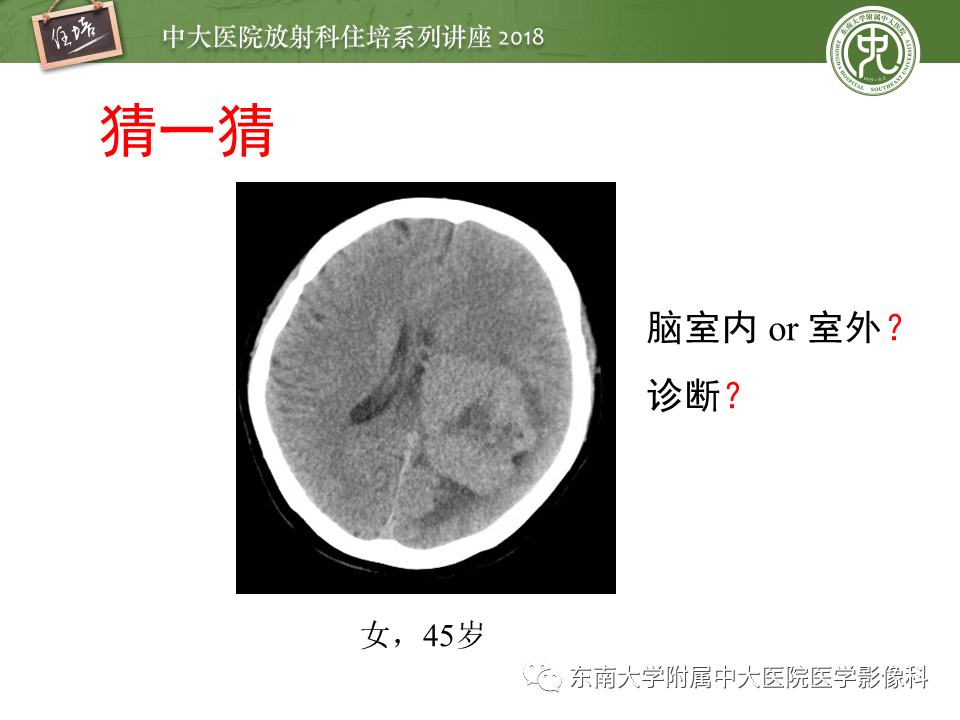 【PPT】脑室内肿瘤的影像学表现及鉴别