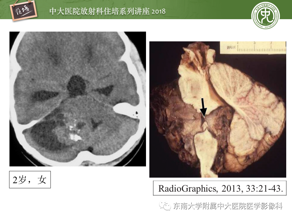 【PPT】脑室内肿瘤的影像学表现及鉴别