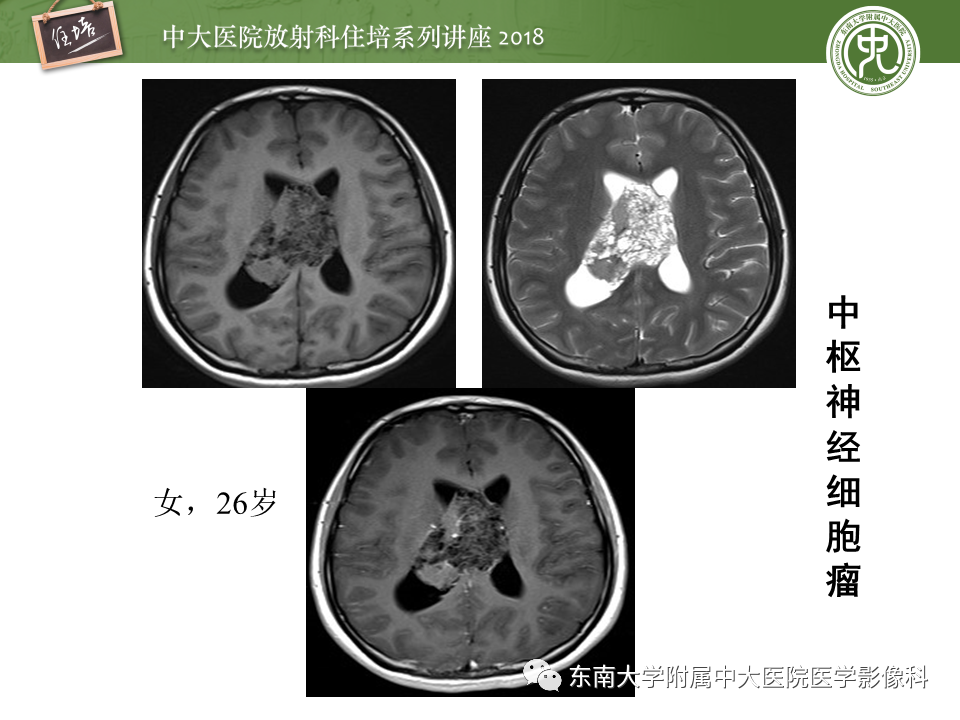 【PPT】脑室内肿瘤的影像学表现及鉴别