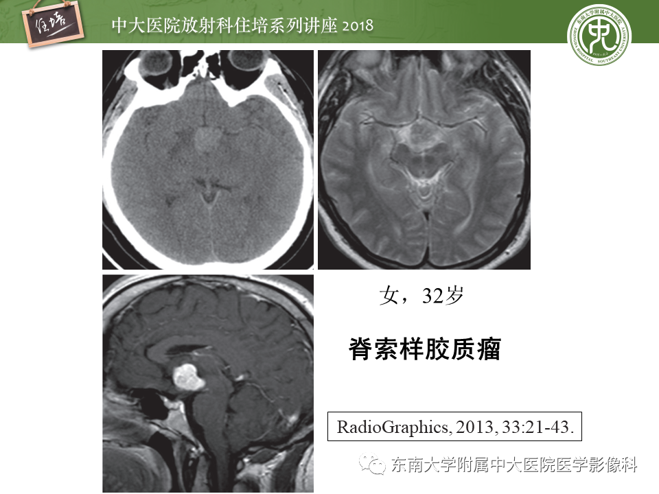 【PPT】脑室内肿瘤的影像学表现及鉴别