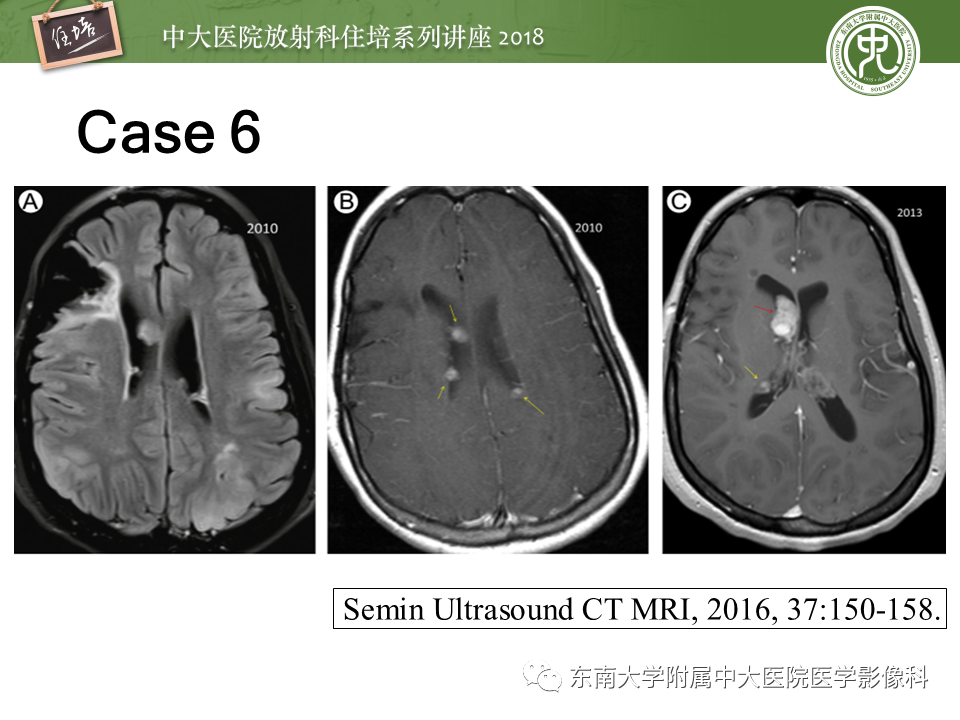 【PPT】脑室内肿瘤的影像学表现及鉴别