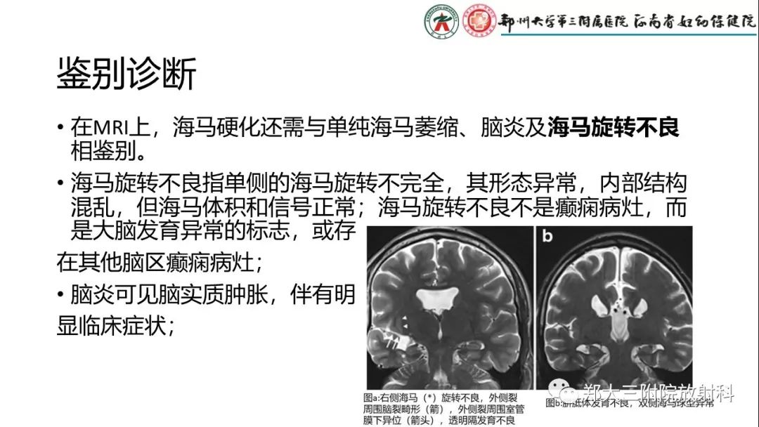 【PPT】海马硬化与癫痫