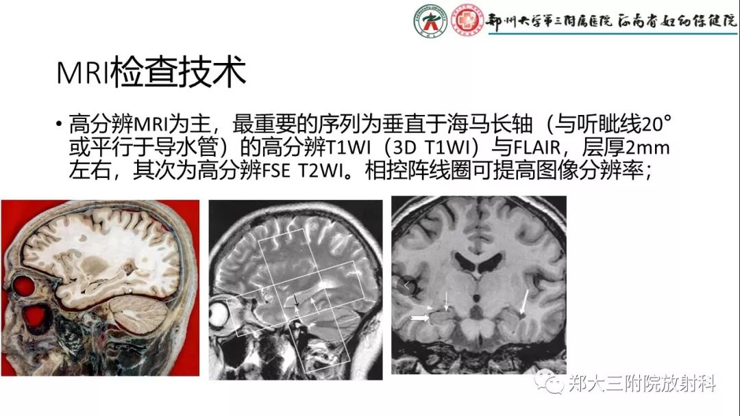 【PPT】海马硬化与癫痫