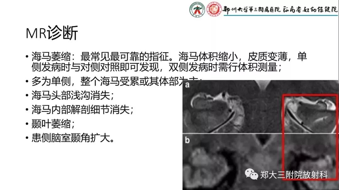 【PPT】海马硬化与癫痫