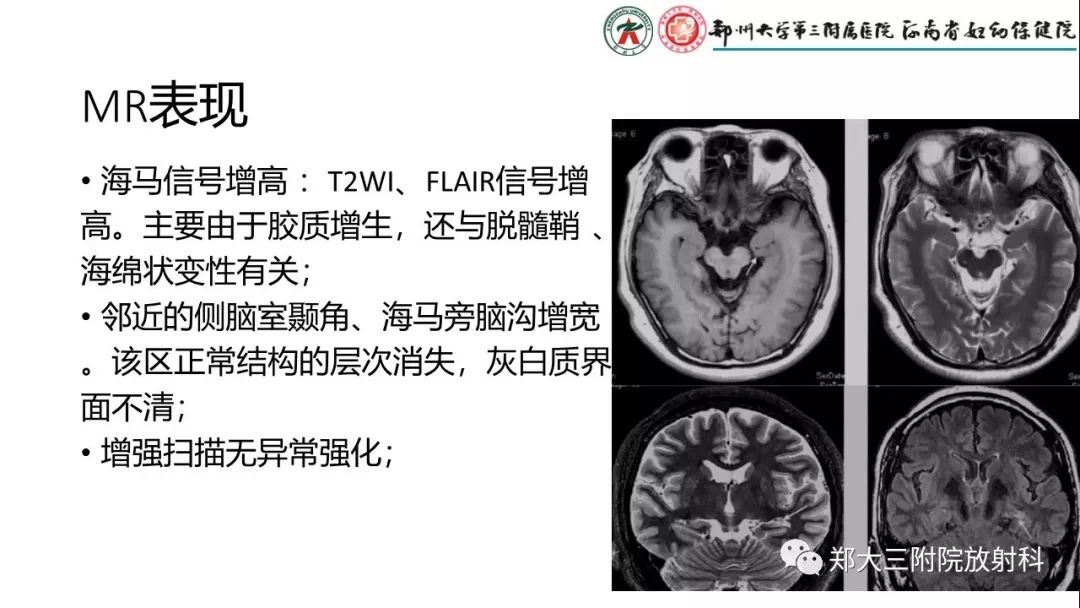 【PPT】海马硬化与癫痫