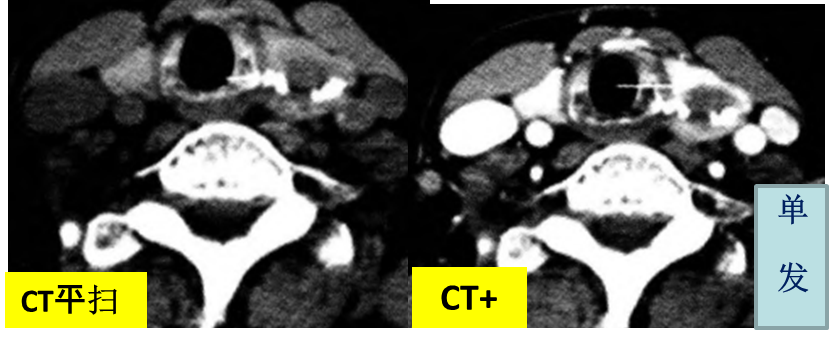 甲状腺结节良恶性的影像鉴别