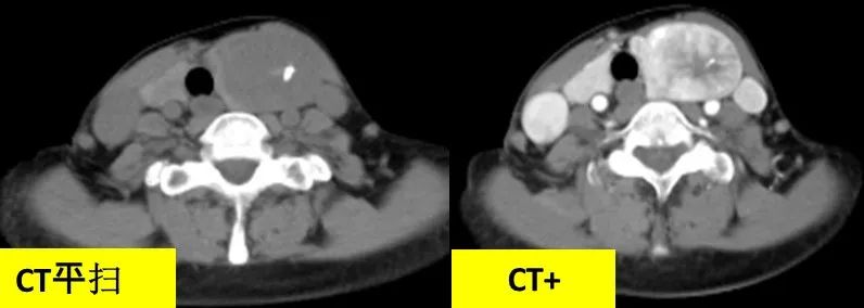 甲状腺结节良恶性的影像鉴别
