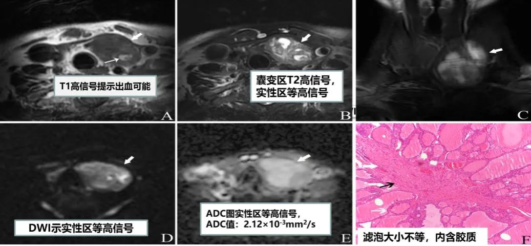 甲状腺结节良恶性的影像鉴别