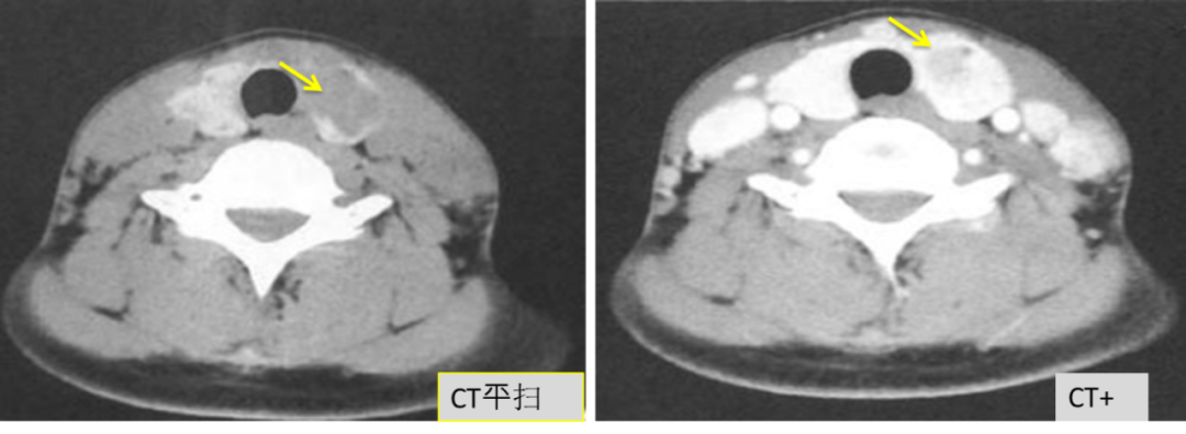 甲状腺结节良恶性的影像鉴别