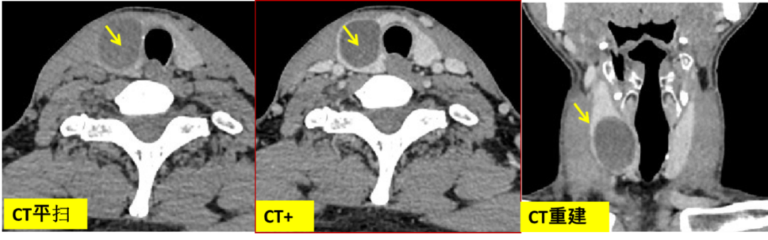 甲状腺结节良恶性的影像鉴别