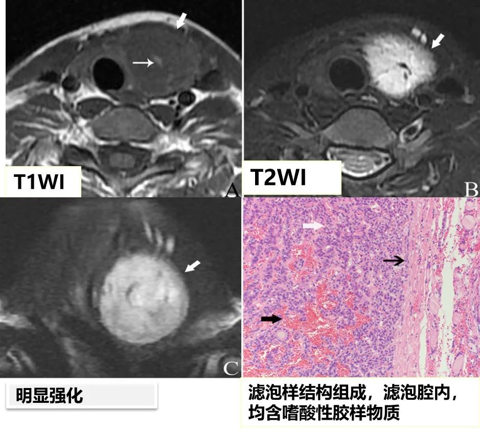 甲状腺结节良恶性的影像鉴别