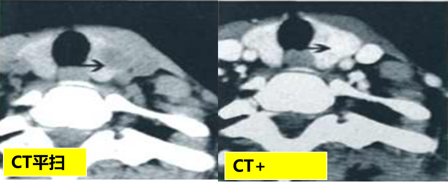 甲状腺结节良恶性的影像鉴别
